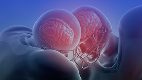 Ilustração de jogadores de futebol americano colidindo com impacto cerebral, representando o curso online Concussão no Esporte da Miami Health Academy.